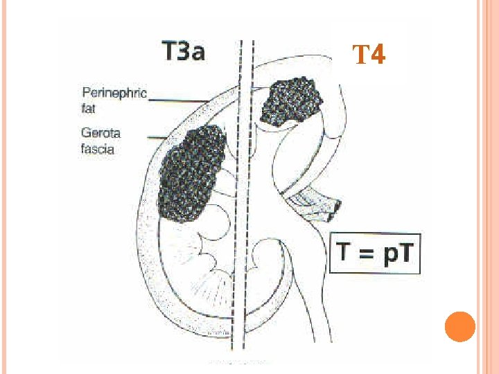 T 4 