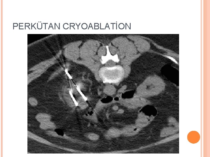 PERKÜTAN CRYOABLATİON 