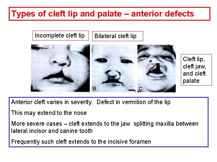 Types of cleft lip and palate – anterior defects Incomplete cleft lip Bilateral cleft