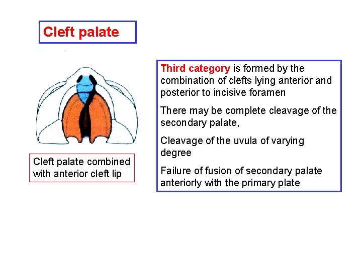 Cleft palate Third category is formed by the combination of clefts lying anterior and