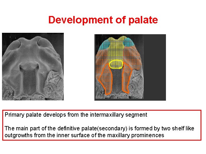 Development of palate Primary palate develops from the intermaxillary segment The main part of