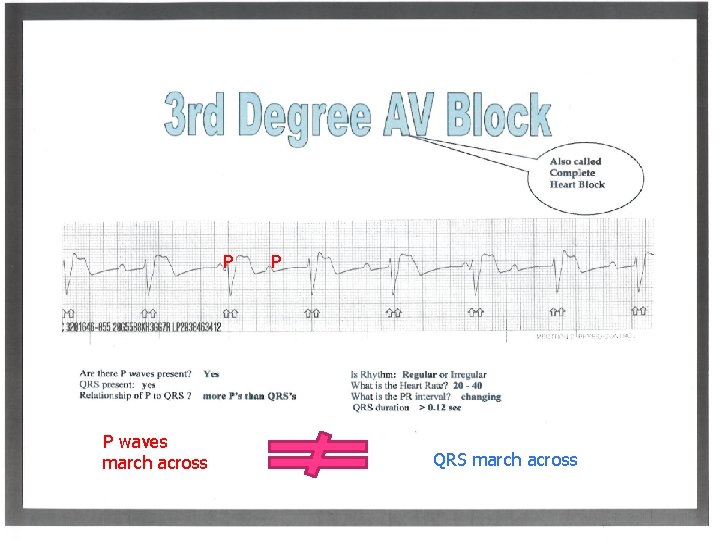 P P waves march across P QRS march across P P waves march across P QRS march across