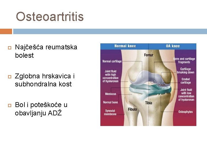 Osteoartritis Najčešća reumatska bolest Zglobna hrskavica i subhondralna kost Bol i poteškoće u obavljanju