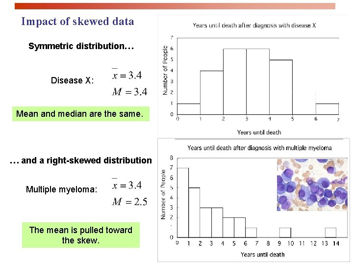 Impact of skewed data Symmetric distribution… Disease X: Mean and median are the same.