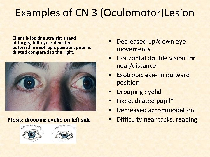 Examples of CN 3 (Oculomotor)Lesion Client is looking straight ahead at target; left eye