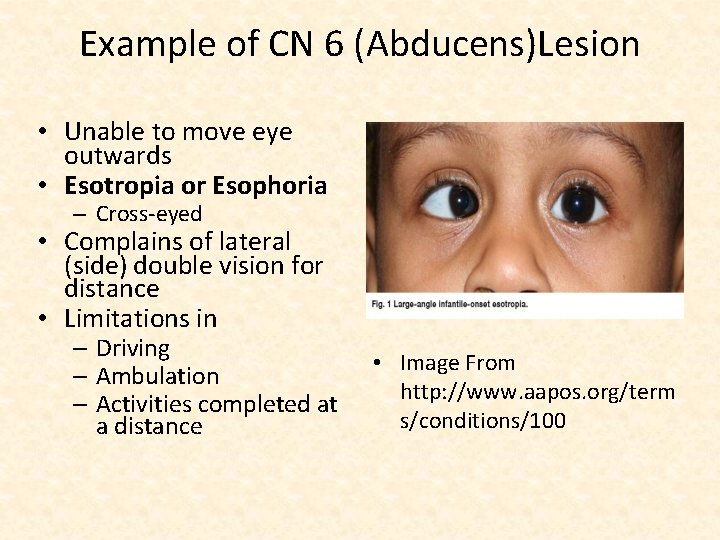 Example of CN 6 (Abducens)Lesion • Unable to move eye outwards • Esotropia or