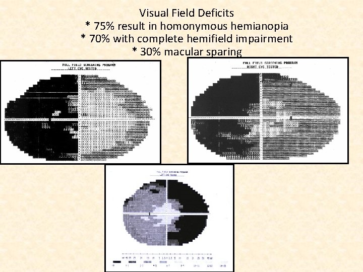 Visual Field Deficits * 75% result in homonymous hemianopia * 70% with complete hemifield