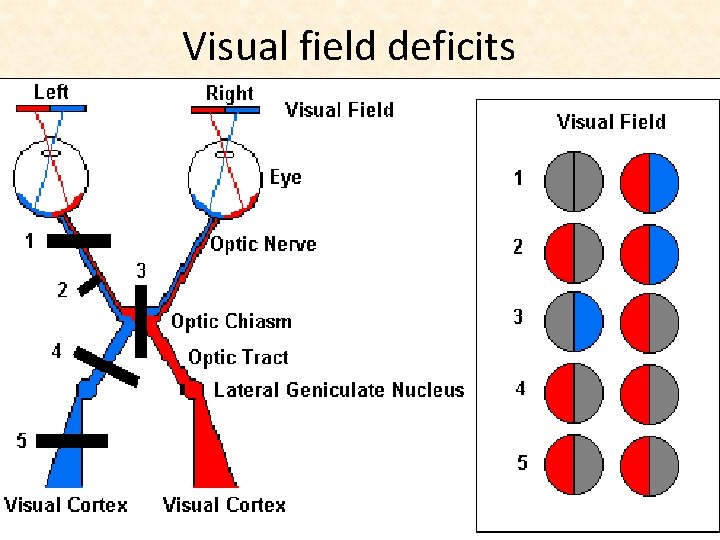 Visual field deficits 