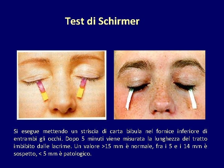Test di Schirmer Si esegue mettendo un striscia di carta bibula nel fornice inferiore