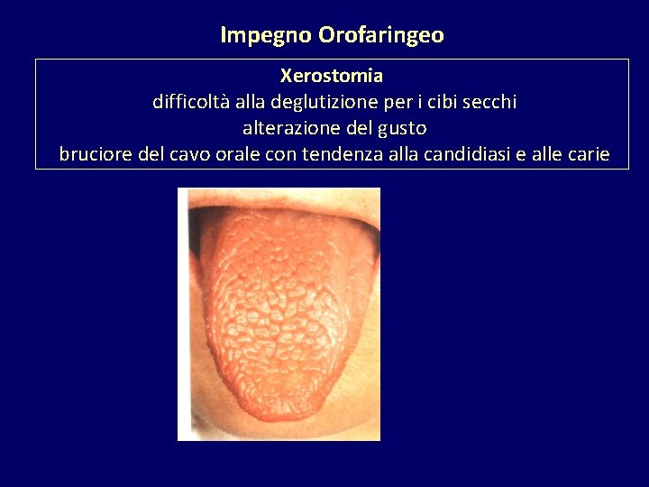Impegno Orofaringeo Xerostomia difficoltà alla deglutizione per i cibi secchi alterazione del gusto bruciore