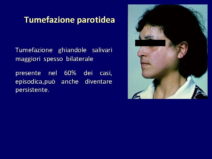 Tumefazione parotidea Tumefazione ghiandole salivari maggiori spesso bilaterale presente nel 60% dei casi, episodica,