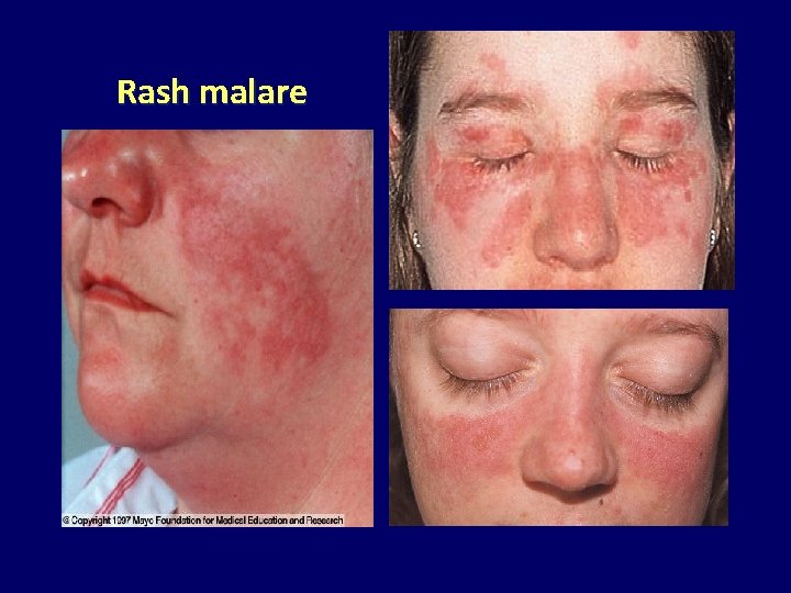 Rash malare 
