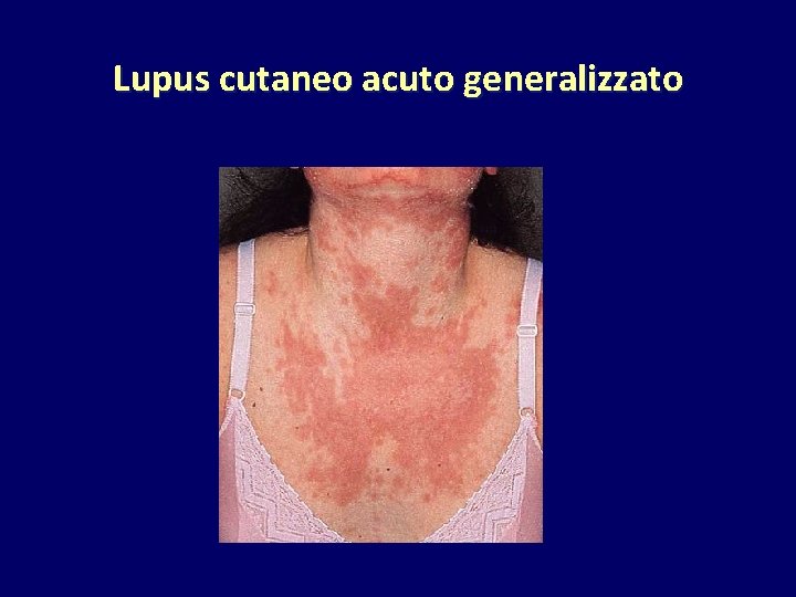 Lupus cutaneo acuto generalizzato 
