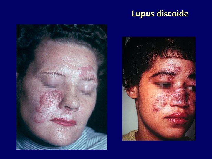 Lupus discoide 