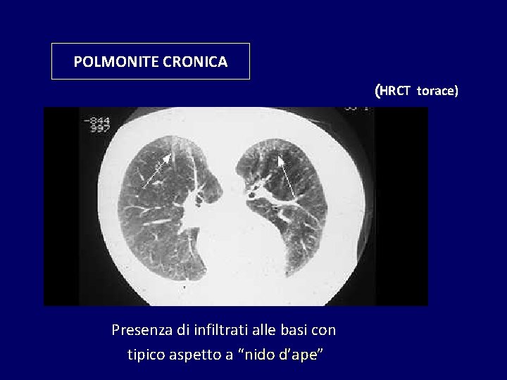 POLMONITE CRONICA (HRCT torace) Presenza di infiltrati alle basi con tipico aspetto a “nido