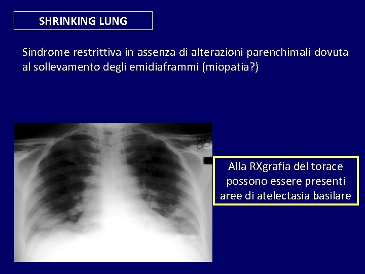 SHRINKING LUNG Sindrome restrittiva in assenza di alterazioni parenchimali dovuta al sollevamento degli emidiaframmi