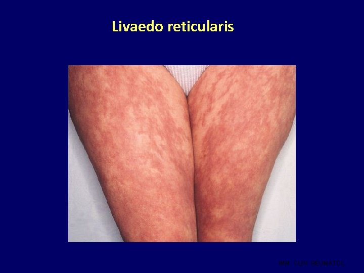 Livaedo reticularis IMM. CLIN. REUMATOL. 