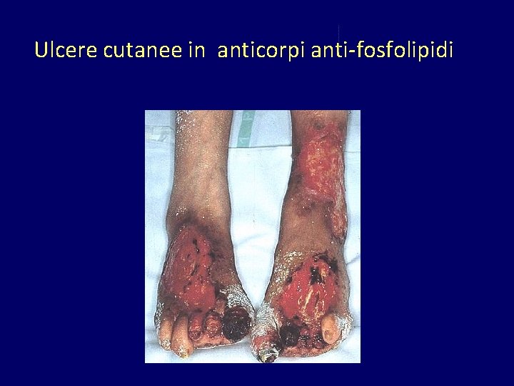 Ulcere cutanee in anticorpi anti-fosfolipidi 