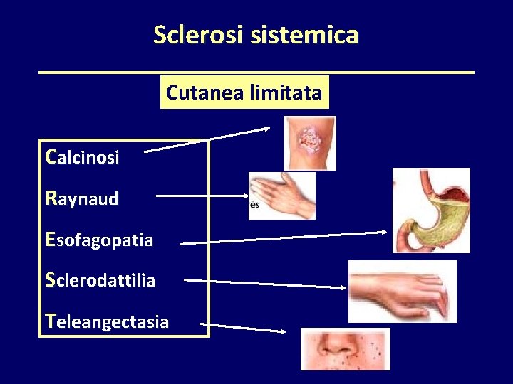 Sclerosi sistemica Cutanea limitata Calcinosi Raynaud Esofagopatia Sclerodattilia Teleangectasia 