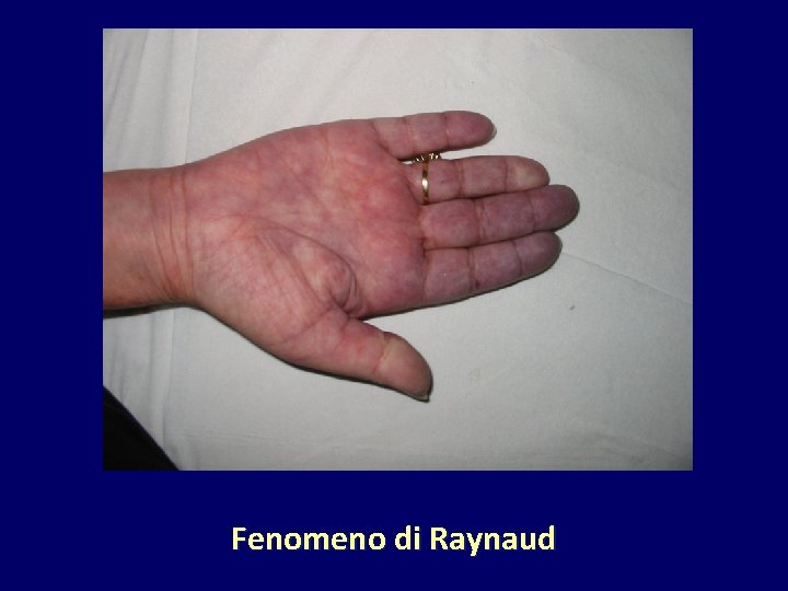 Fenomeno di Raynaud 