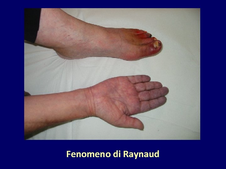 Fenomeno di Raynaud 