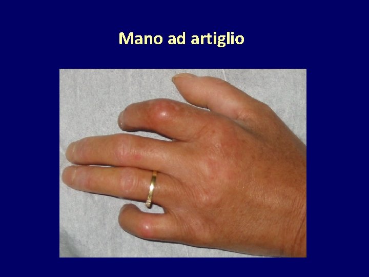 Mano ad artiglio 