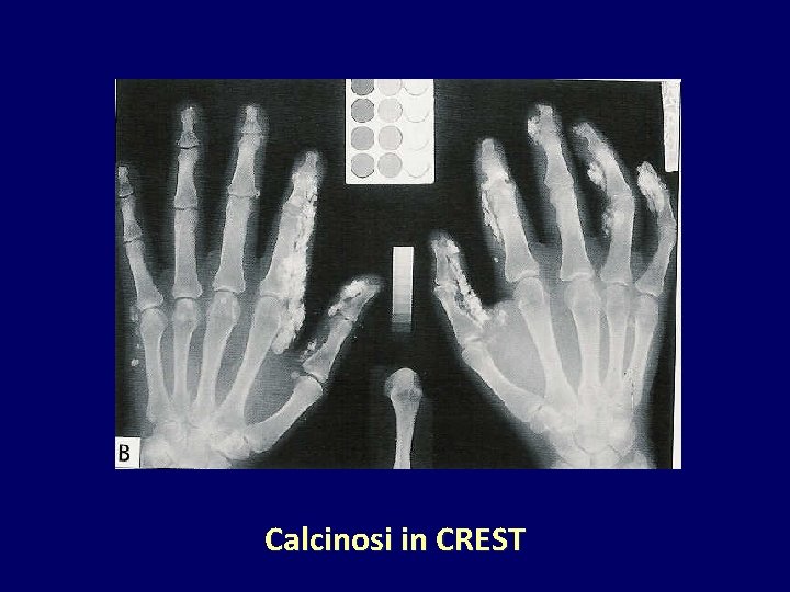 Calcinosi in CREST 