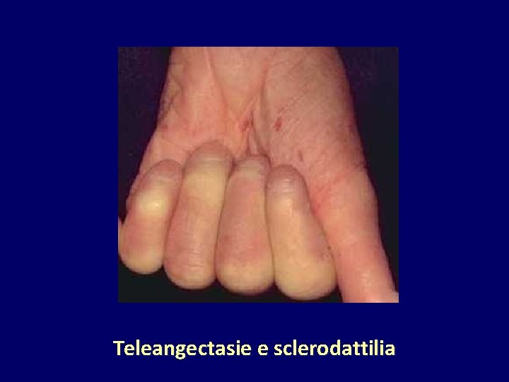 Teleangectasie e sclerodattilia 