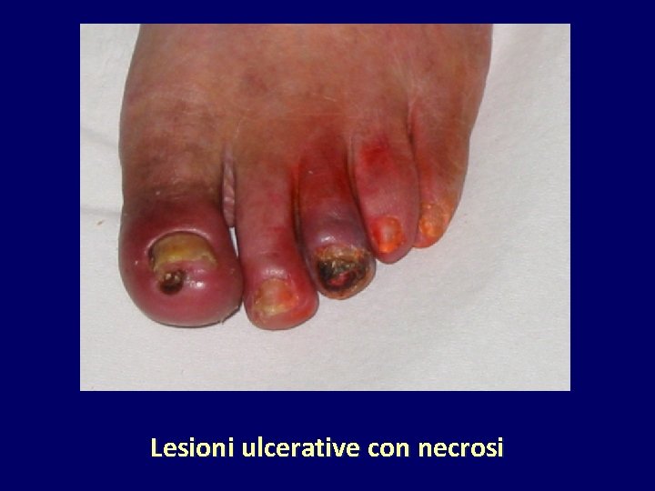 Lesioni ulcerative con necrosi 