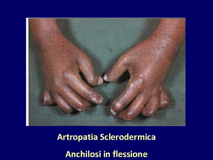 Artropatia Sclerodermica Anchilosi in flessione 