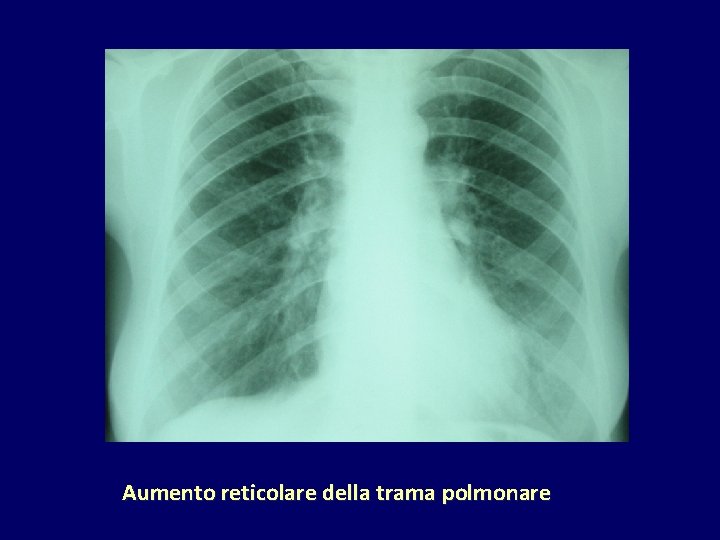 Aumento reticolare della trama polmonare 