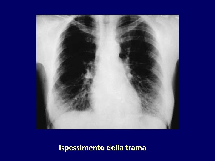Ispessimento della trama 
