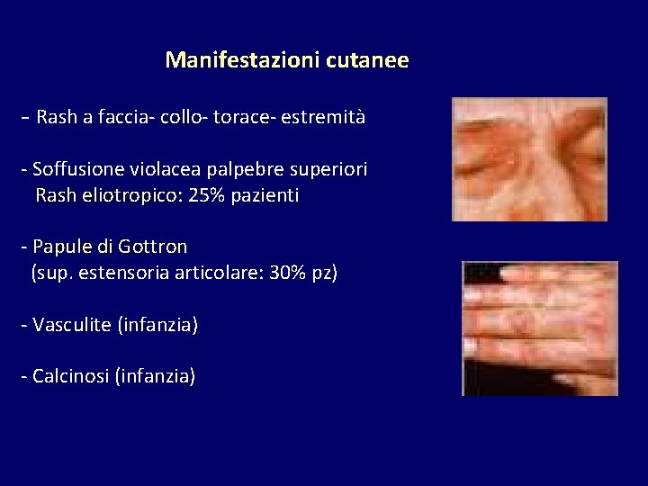 Manifestazioni cutanee - Rash a faccia- collo- torace- estremità - Soffusione violacea palpebre superiori