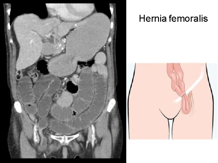 Hernia femoralis 