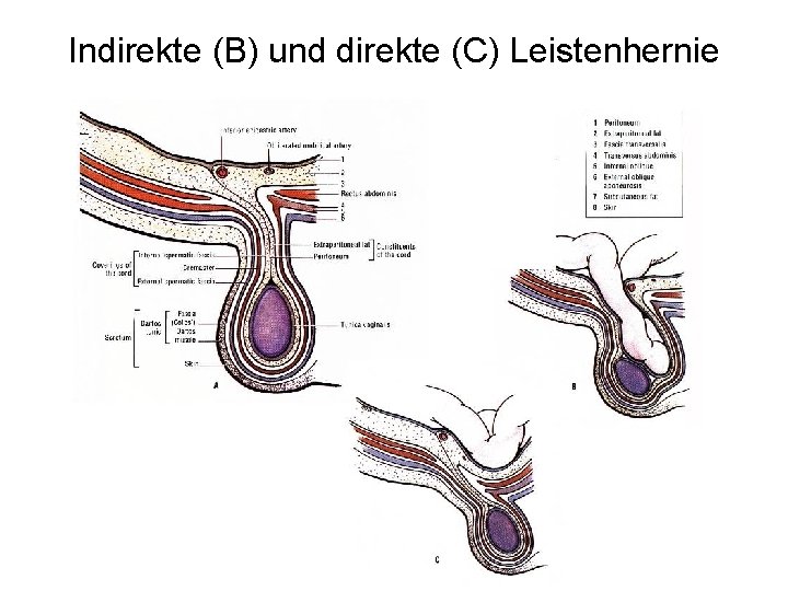 Indirekte (B) und direkte (C) Leistenhernie 