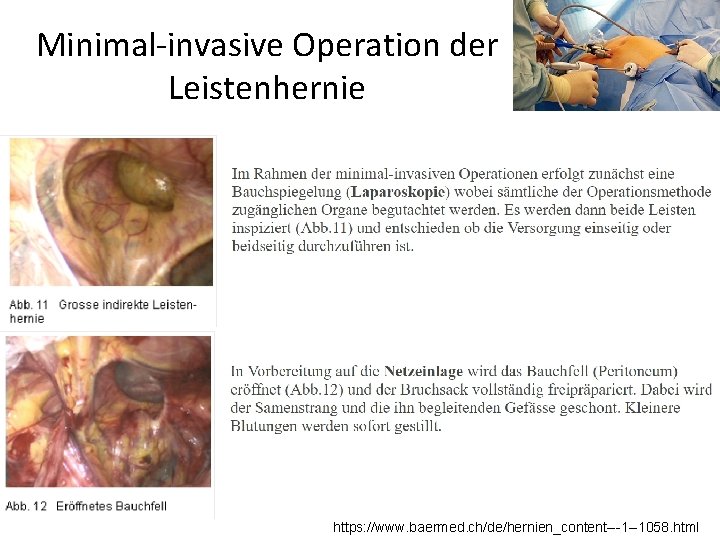 Minimal-invasive Operation der Leistenhernie https: //www. baermed. ch/de/hernien_content---1 --1058. html 