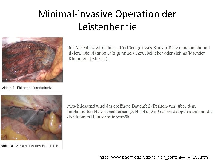 Minimal-invasive Operation der Leistenhernie https: //www. baermed. ch/de/hernien_content---1 --1058. html 