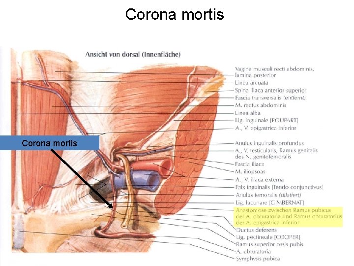 Corona mortis Netter: Atlas of Human Anatomy Anastomózis az a. iliaca externa és az