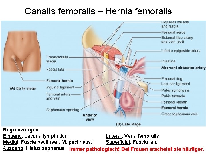 Canalis femoralis – Hernia femoralis Begrenzungen Eingang: Lacuna lymphatica Lateral: Vena femoralis Medial: Fascia