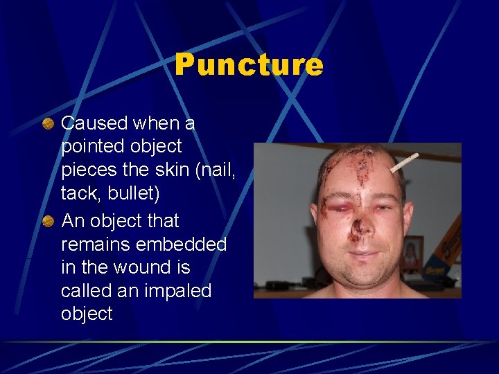 Puncture Caused when a pointed object pieces the skin (nail, tack, bullet) An object