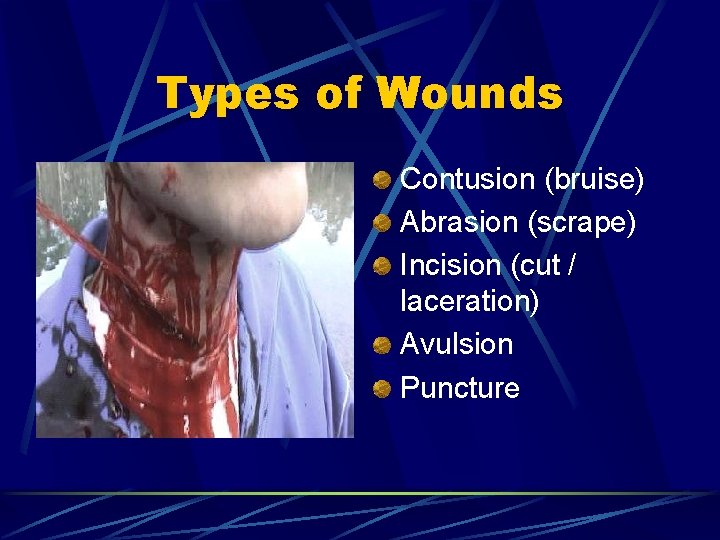 Types of Wounds Contusion (bruise) Abrasion (scrape) Incision (cut / laceration) Avulsion Puncture  Types of Wounds Contusion (bruise) Abrasion (scrape) Incision (cut / laceration) Avulsion Puncture