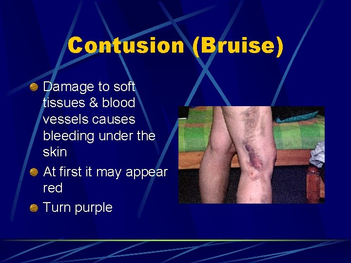 Contusion (Bruise) Damage to soft tissues & blood vessels causes bleeding under the skin Contusion (Bruise) Damage to soft tissues & blood vessels causes bleeding under the skin
