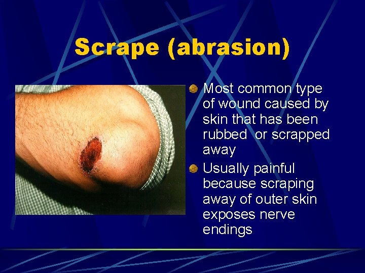 Scrape (abrasion) Most common type of wound caused by skin that has been rubbed