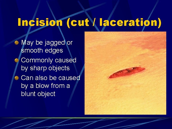 Incision (cut / laceration) May be jagged or smooth edges Commonly caused by sharp Incision (cut / laceration) May be jagged or smooth edges Commonly caused by sharp