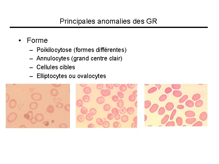 Principales anomalies des GR • Forme – – Poikilocytose (formes différentes) Annulocytes (grand centre