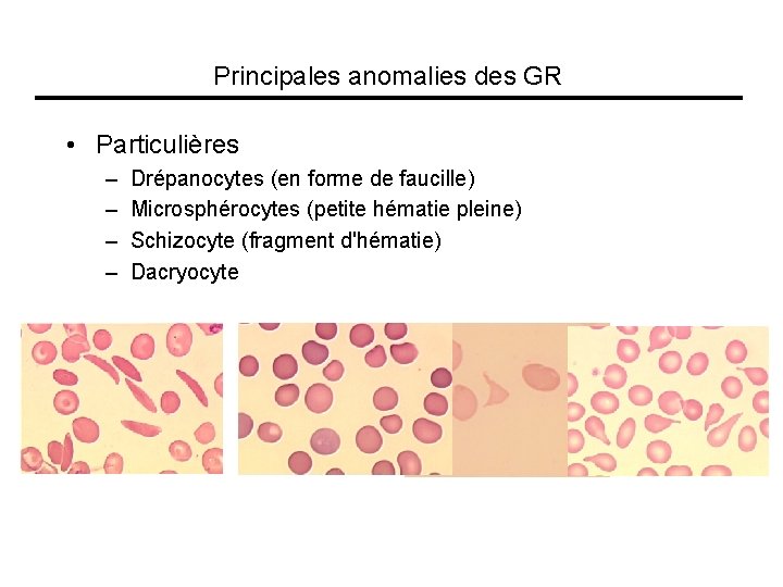 Principales anomalies des GR • Particulières – – Drépanocytes (en forme de faucille) Microsphérocytes