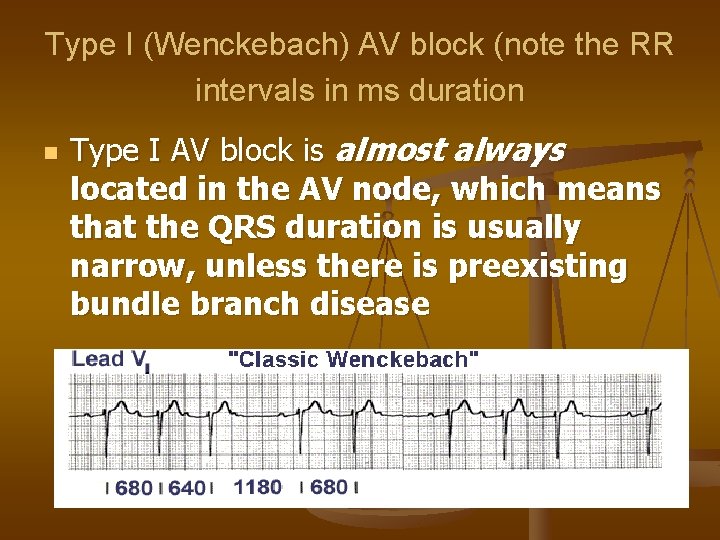 Type I (Wenckebach) AV block (note the RR intervals in ms duration n Type