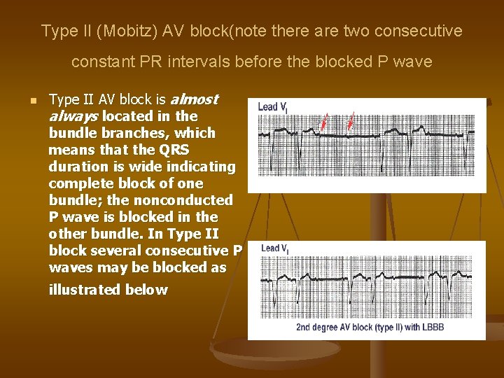 Type II (Mobitz) AV block(note there are two consecutive constant PR intervals before the