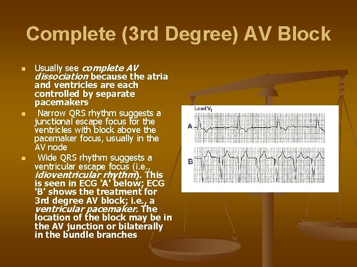 Complete (3 rd Degree) AV Block n n n Usually see complete AV dissociation