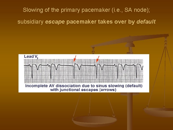 Slowing of the primary pacemaker (i. e. , SA node); subsidiary escape pacemaker takes